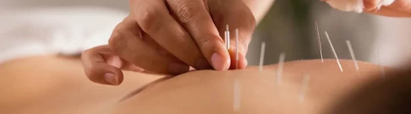 Akupunktur